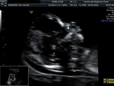 Ecografía del primer trimestre en Lima. 