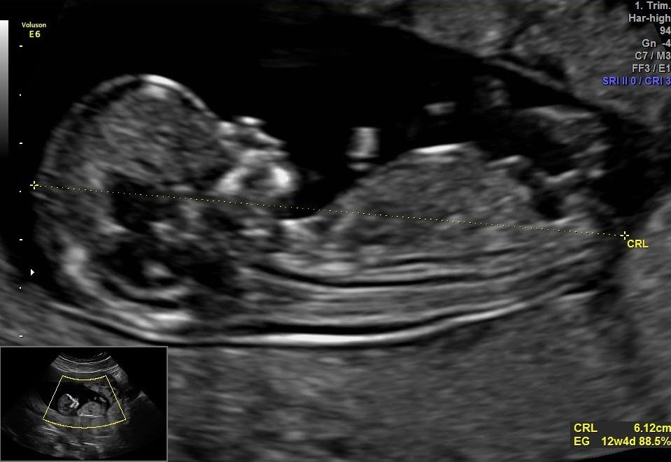 ecografía de primer trimestre genetica TN CENMEF Medicina Fetal
