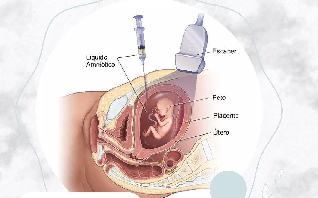 Procedimiento Invasivo: Amniocentésis